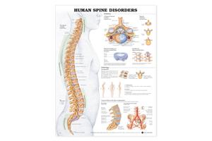 Disorders Of The Spine Poster 20&quot X 30&quot