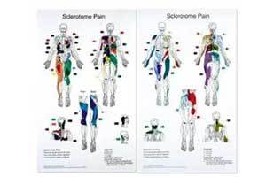 Sclerotome Pain Charts 22 X 36